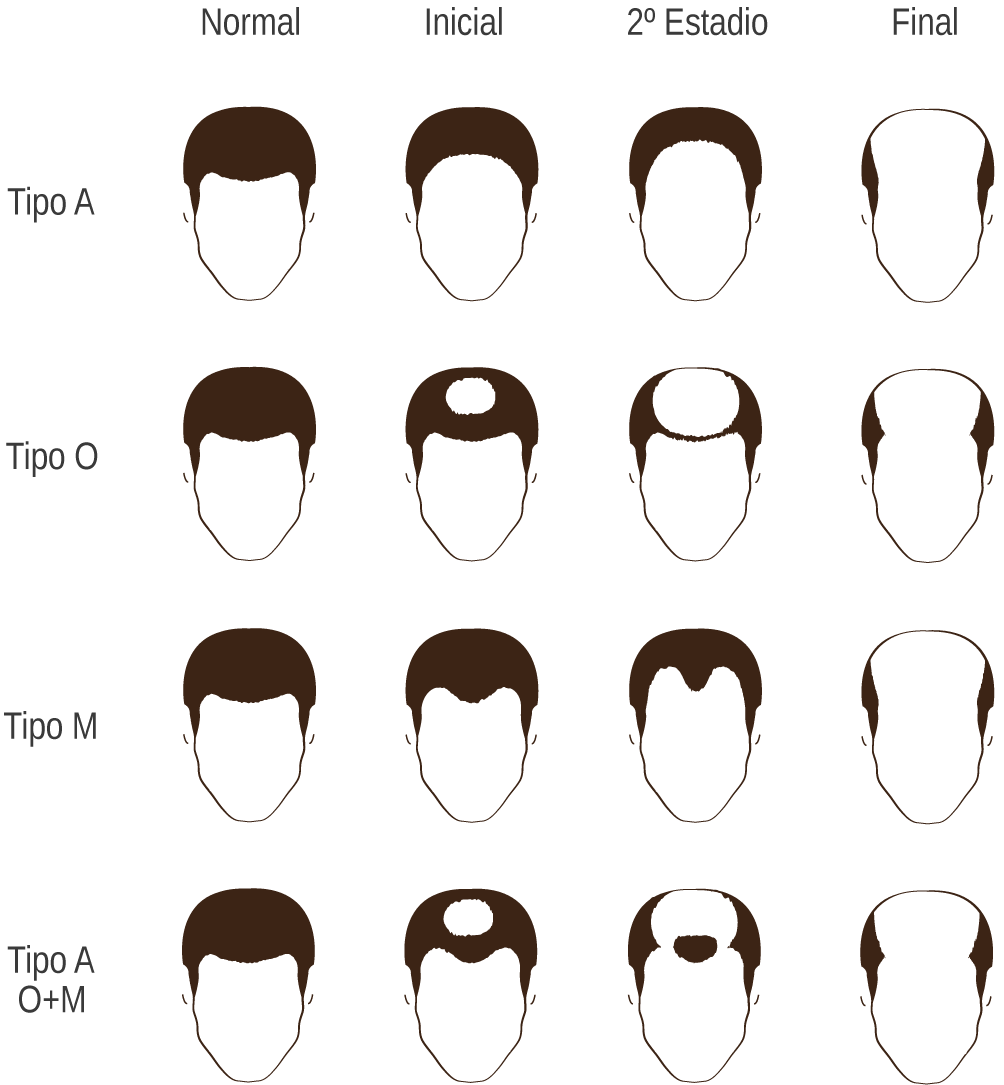 Tipos de alopecia y fases