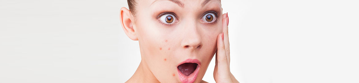 tratamiento de medicina estética para terminar con el acné y sus secuelas