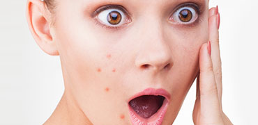 tratamiento anti acné en CEME