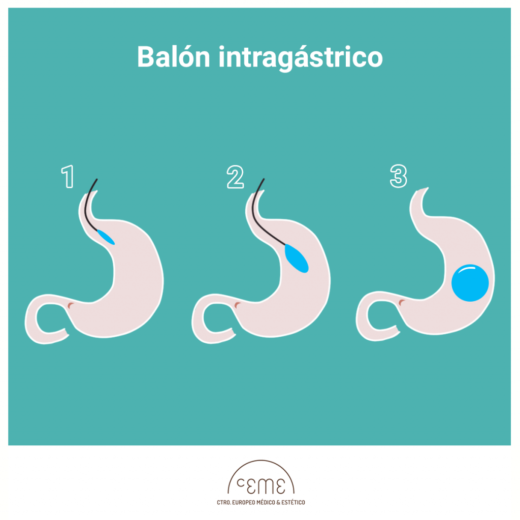Balón Intragástrico el método para perder peso y no recuperarlo