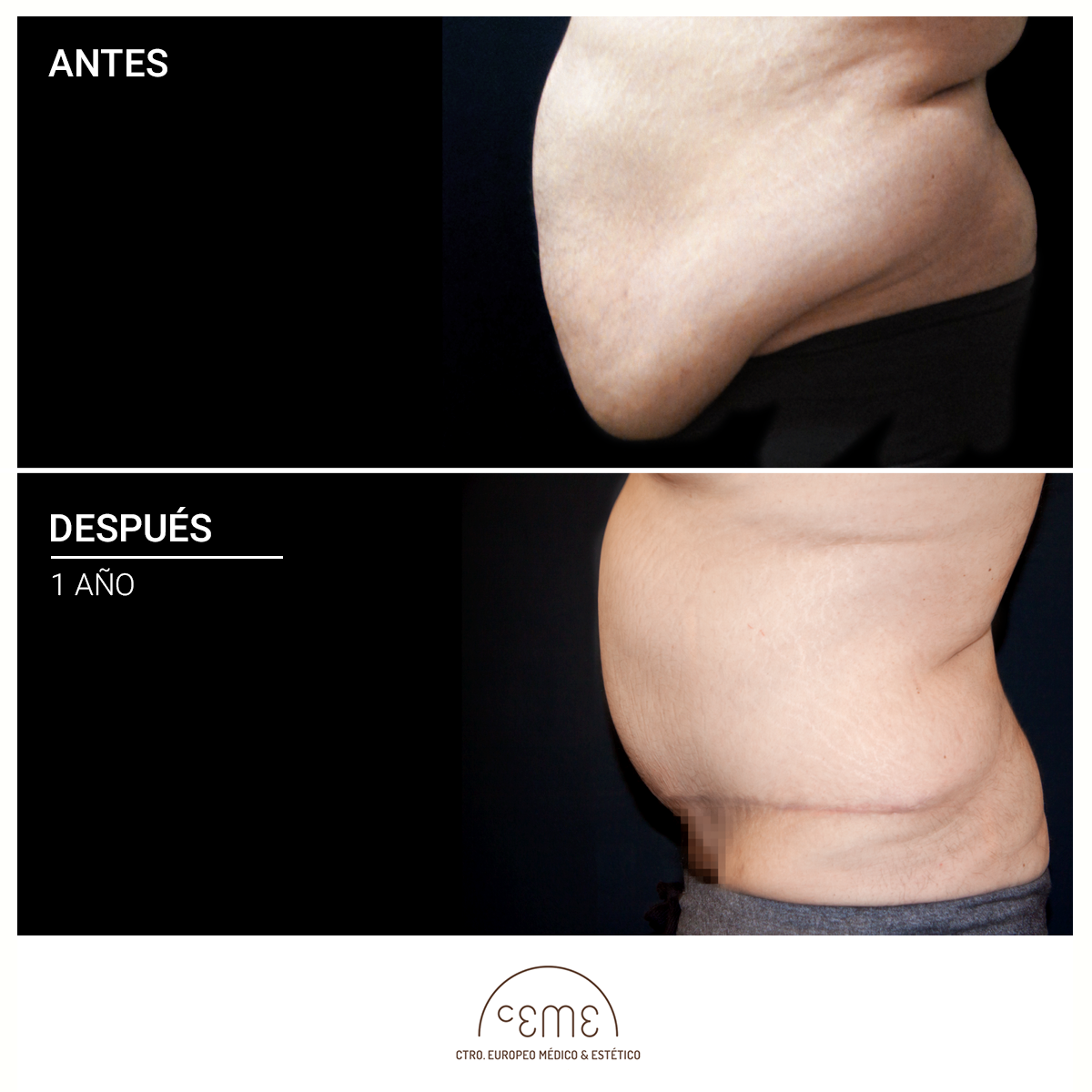 ABDOMINOPLASTIA ANTONIO ALVAREZ
