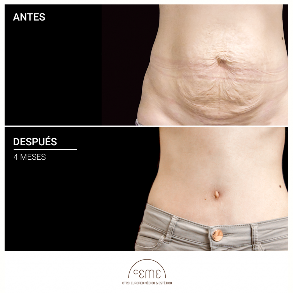 Abdominoplastia CEME Centro Europeo Médico Estético