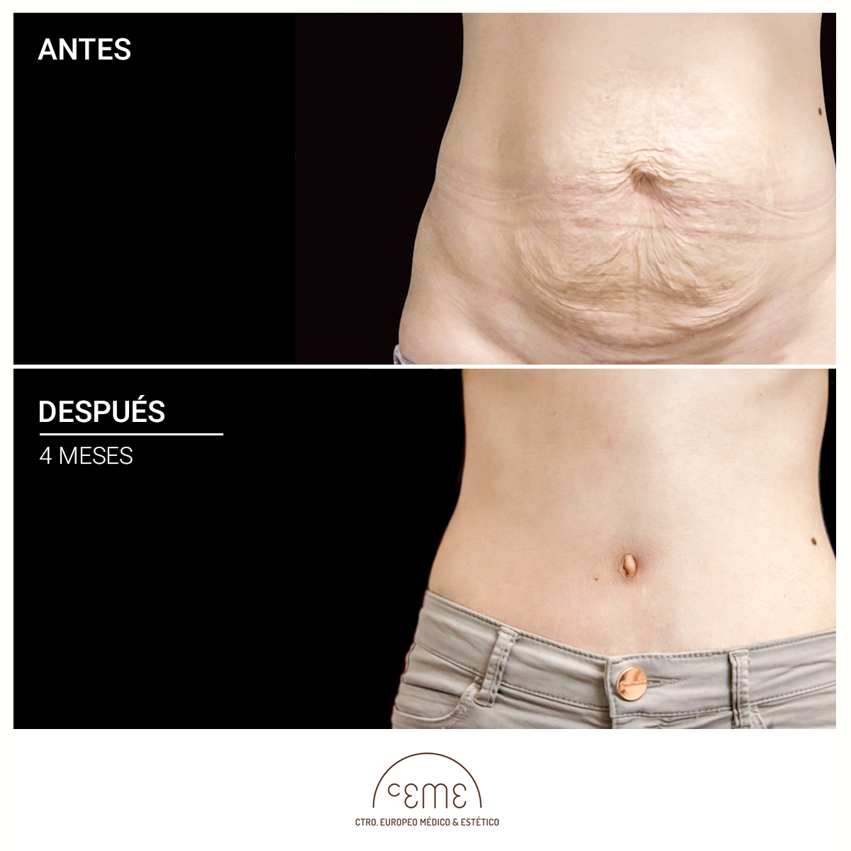 abdominoplastia resultados