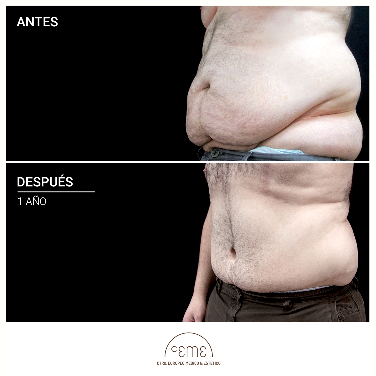 abdominoplastia