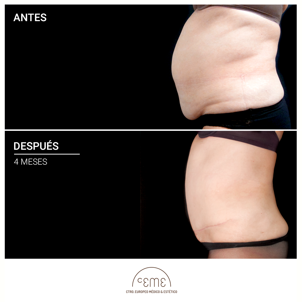 abdominoplastia antes y después