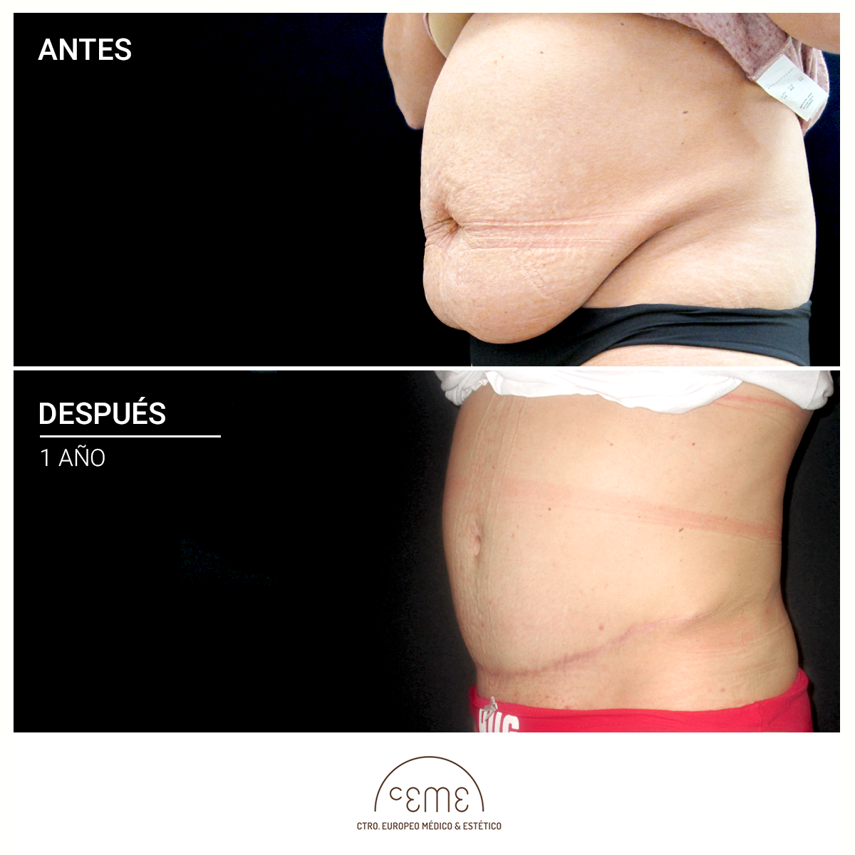 resultados de abdominoplastia