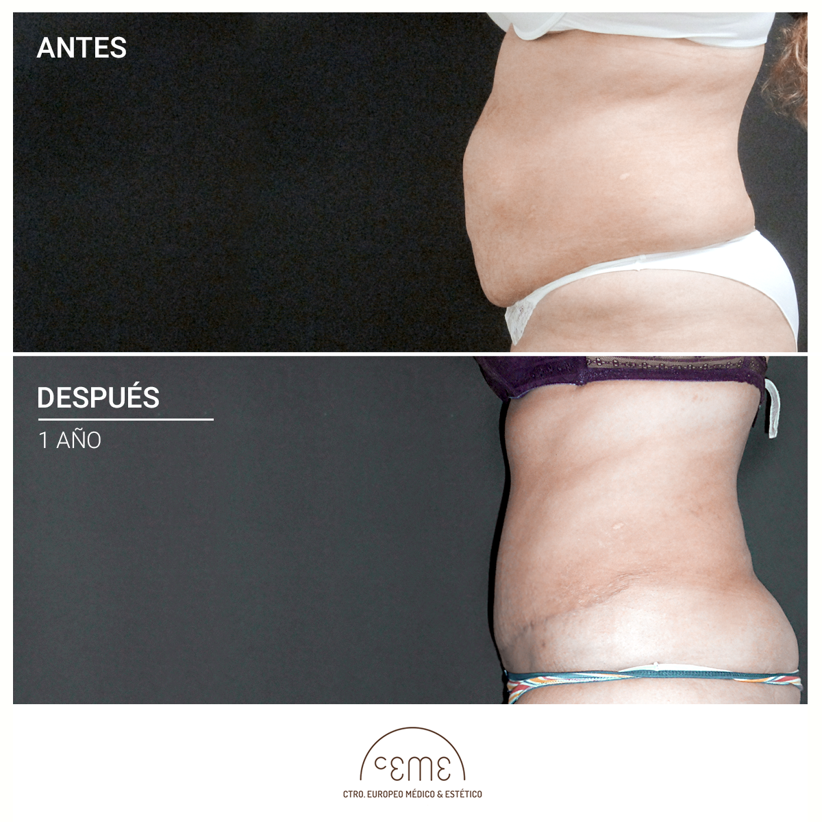 Abdominoplastia AD CEME