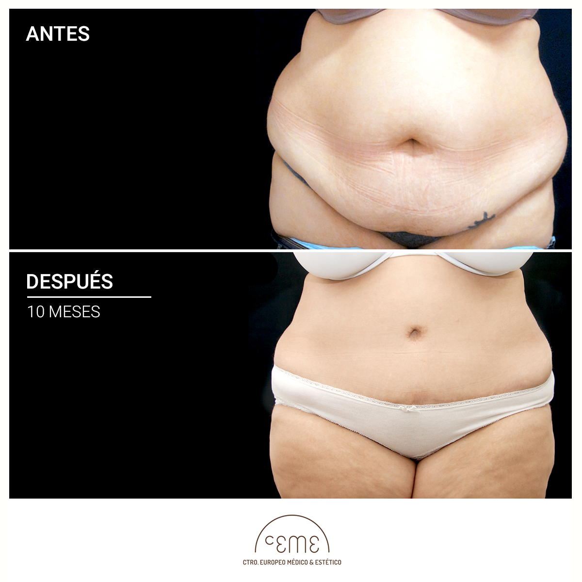 Abdominoplastia: Todo lo que necesitas saber - Clínica Centromed