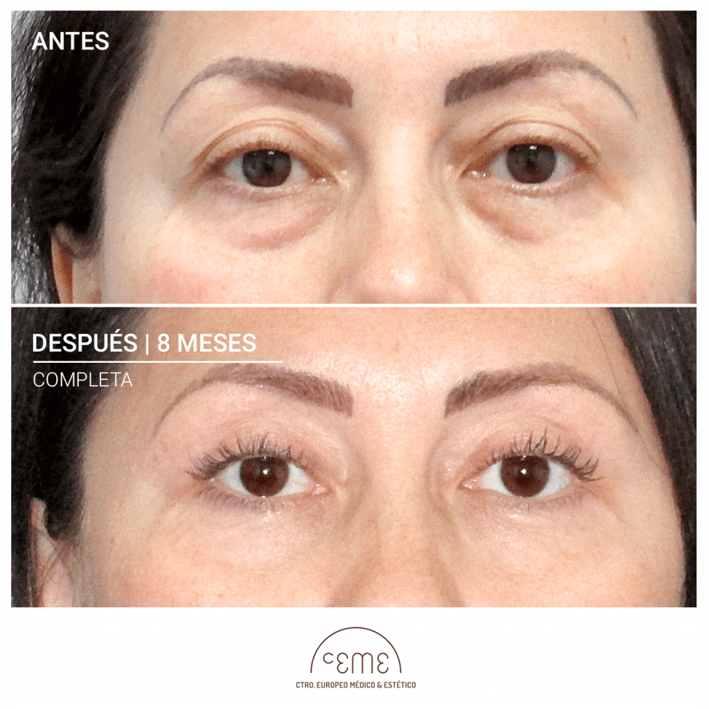 CEME Blefaroplastia