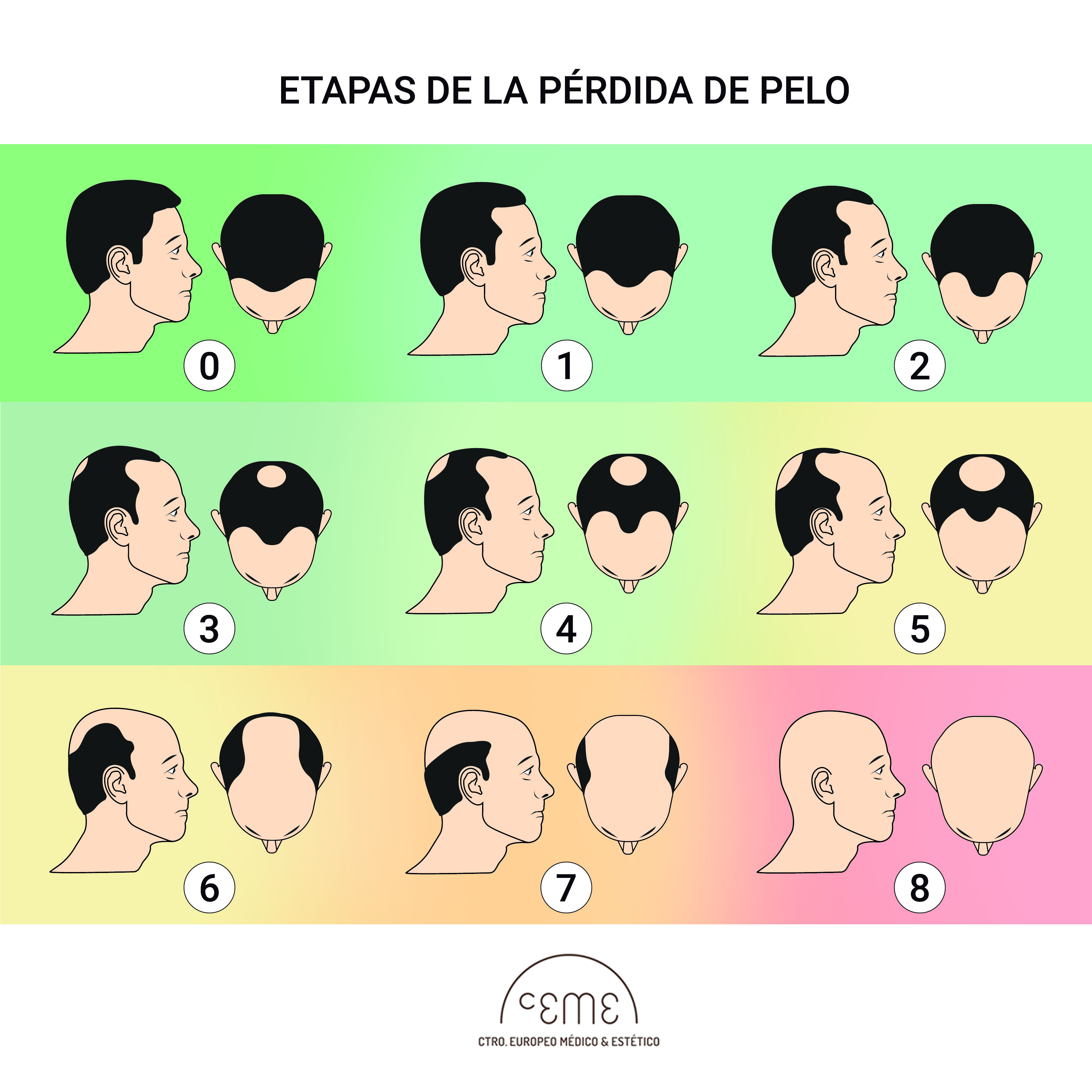 Etapas pérdida de pelo