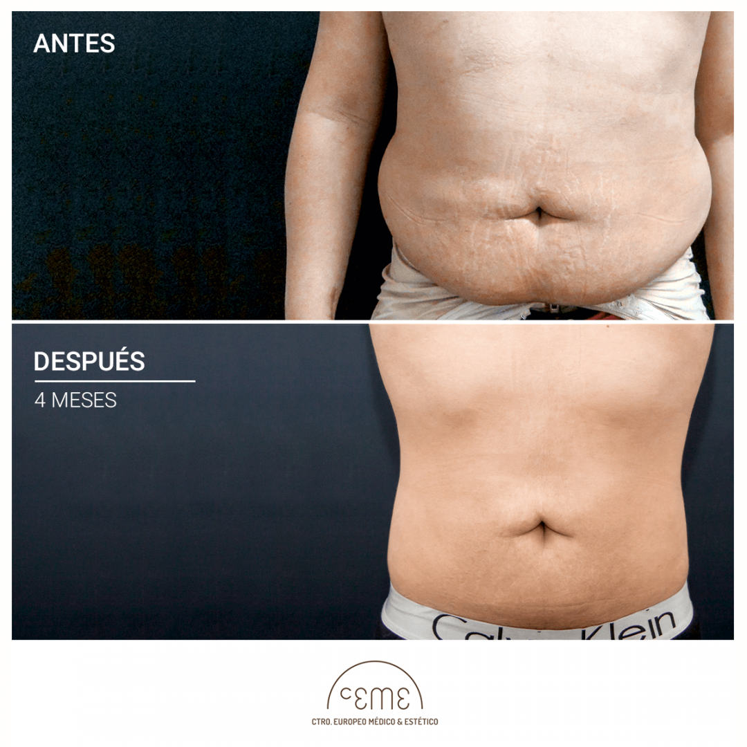 Liposuccion Antes Y Despues Fotos CEME- Liposucción