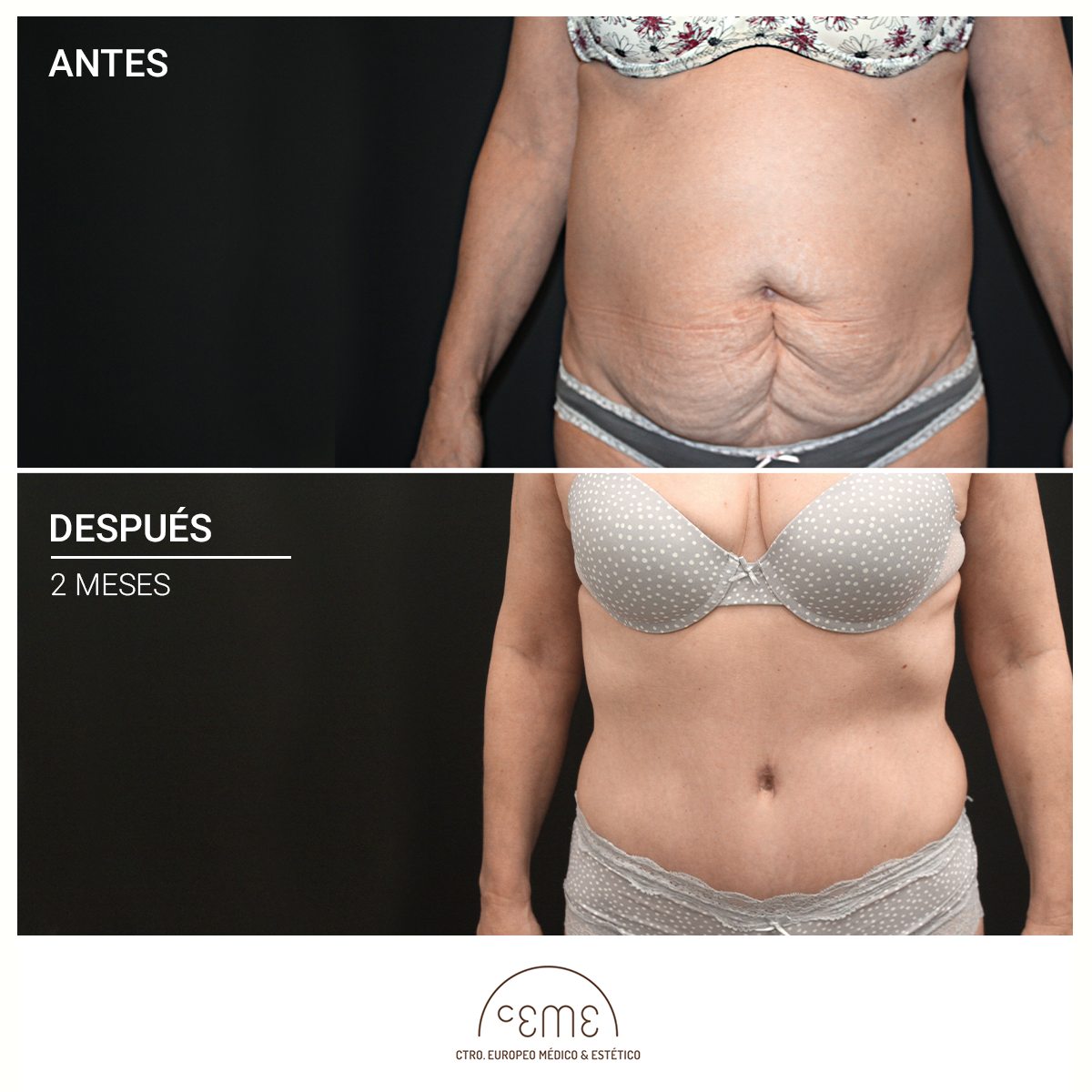 RESULTADOS ABDOMINOPLASTIA