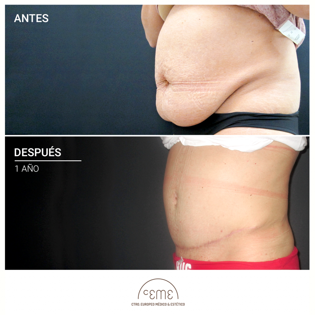 abdominoplastia madrid ceme