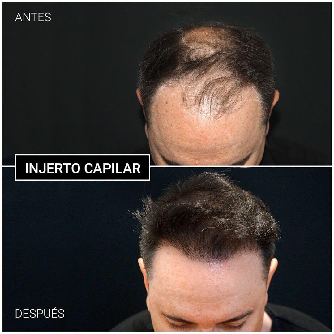 Injerto capilar madrid