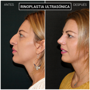 Rinoplastia ultrasónica resultados