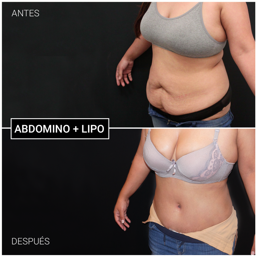 abdominoplastia ceme madrid