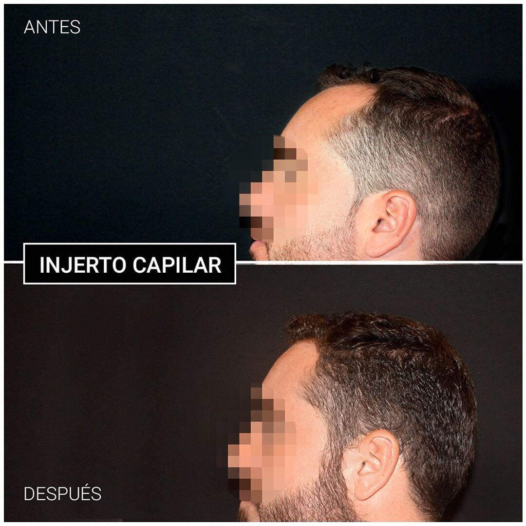 antes y después injerto capilar ceme