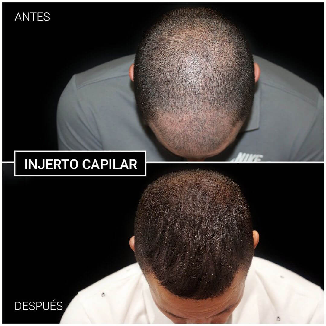 injerto capilar antes y después