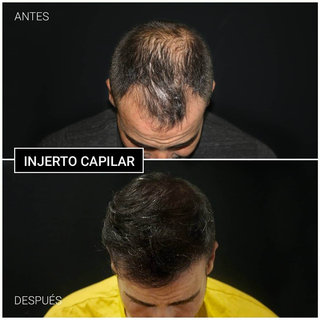 injerto capilar ceme