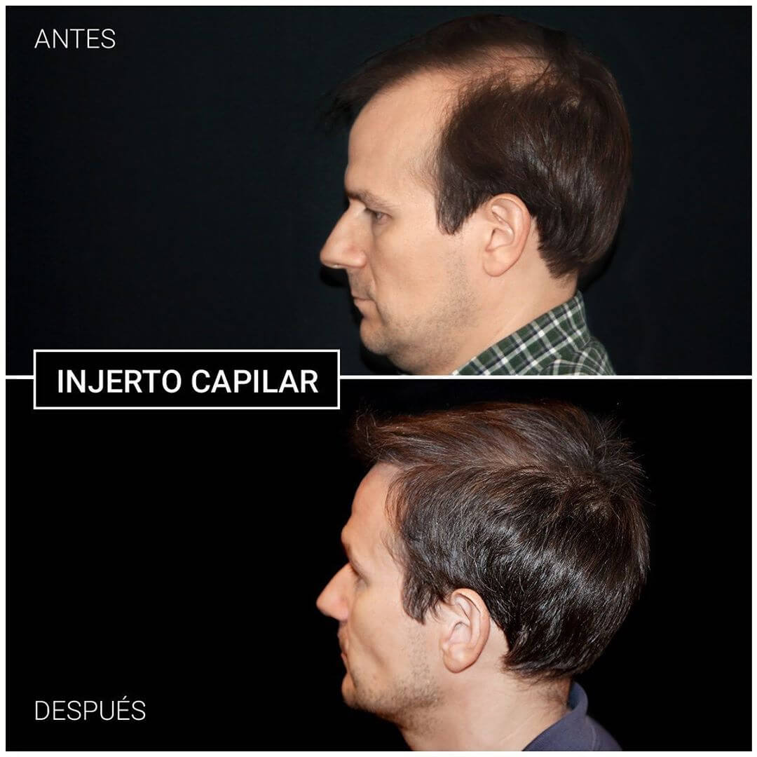 resultados de injerto capilar en madrid