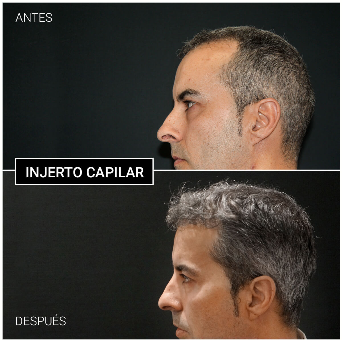 Injerto capilar en CEME (1)