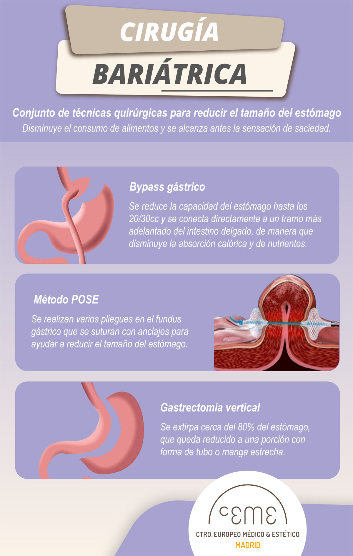 Infoggrafia Reducción de estómago 