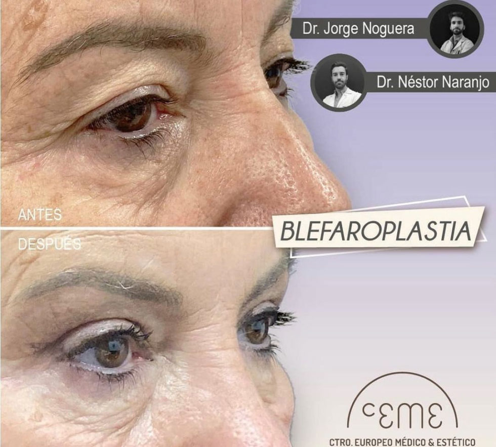 Blefaroplastia Antes y Después - Ceme