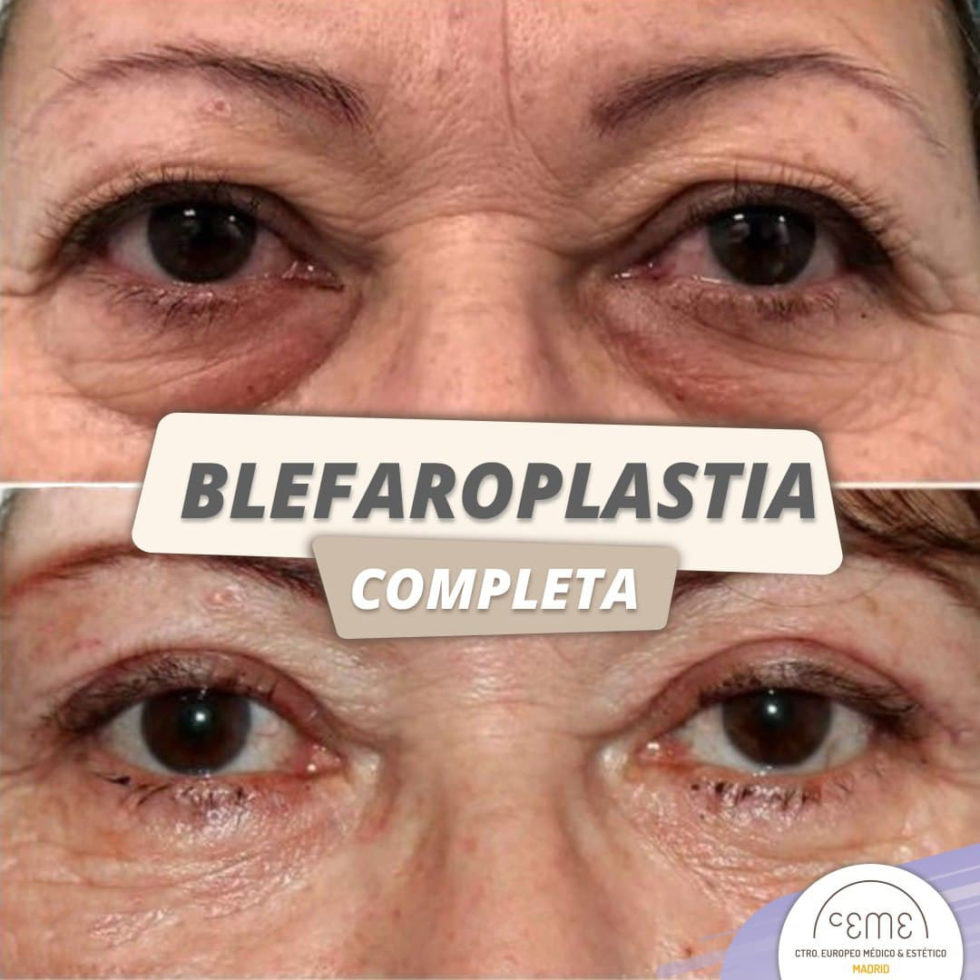 Blefaroplastia Antes y Después - Ceme