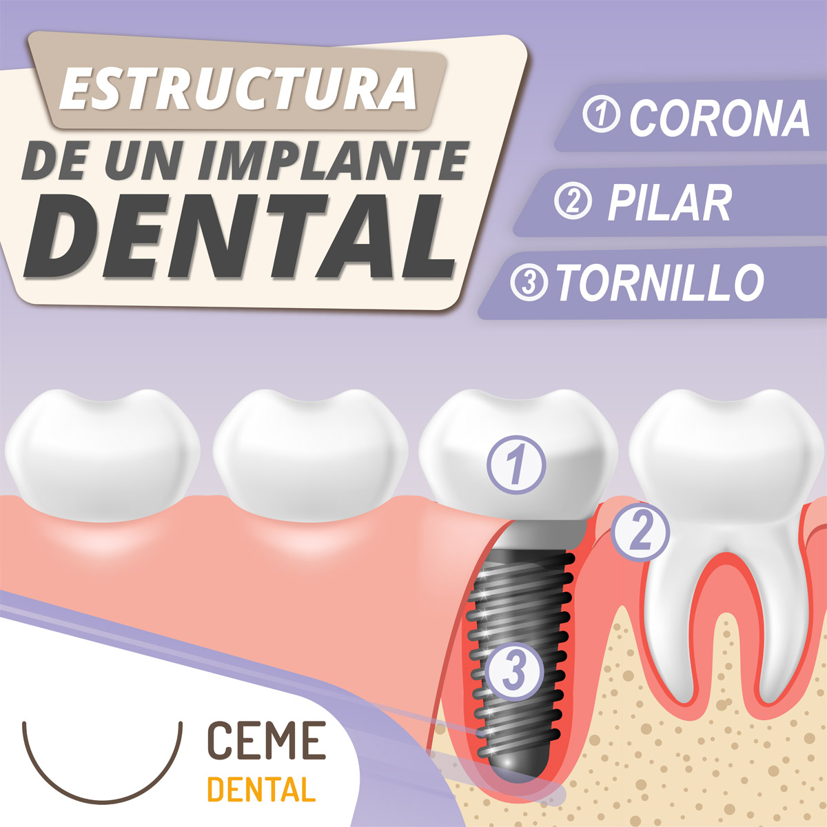 halcón herir Popa Implante Dental: Precio y todo lo que tienes que saber - Ceme