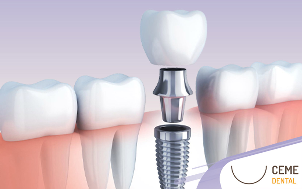 Implante Dental Precio y todo lo que tienes que saber Ceme