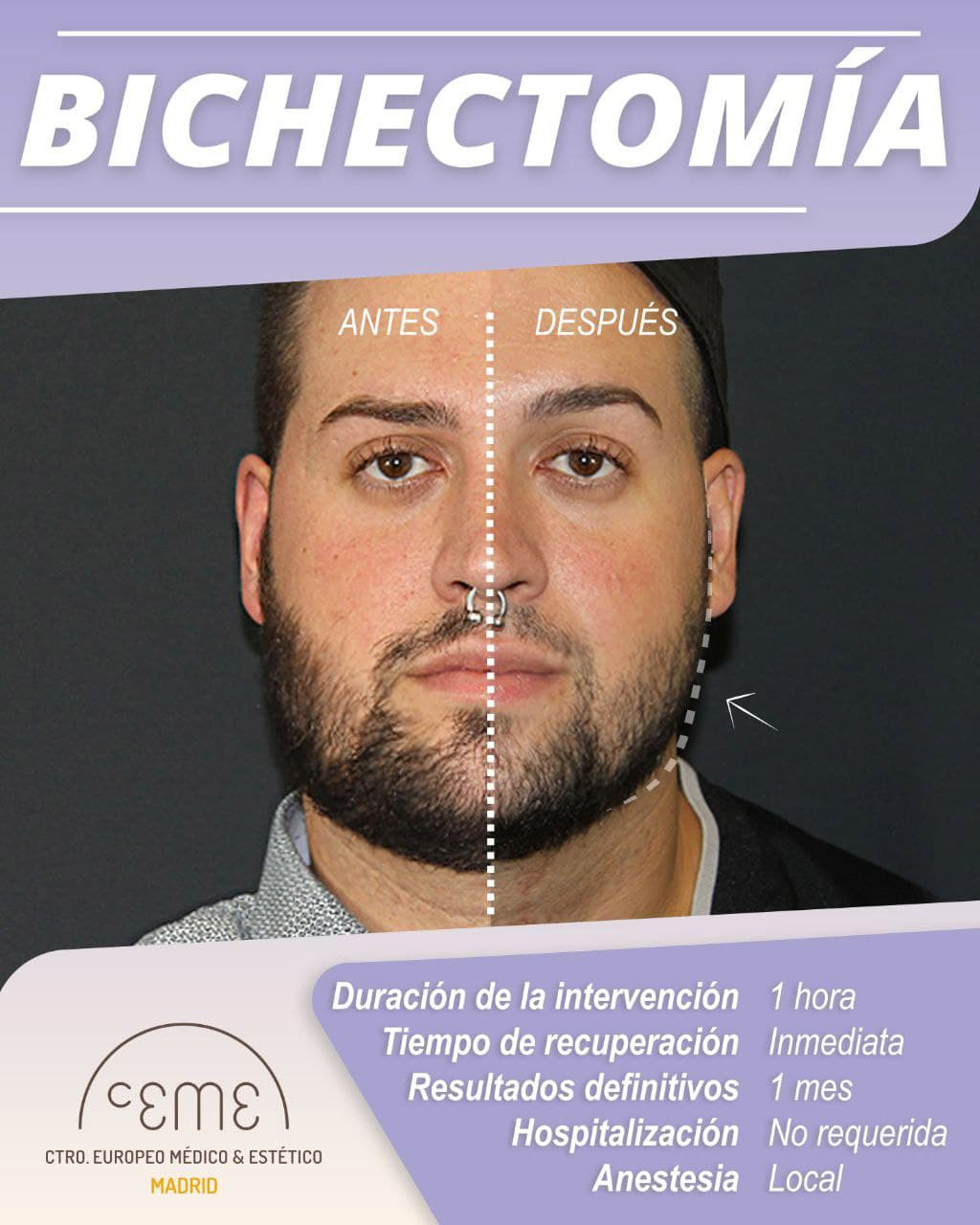 Qué es la bichectomía y por qué es la intervención estética más