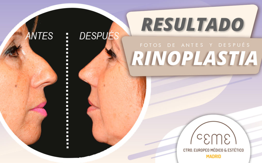 Rinoplastia antes y después