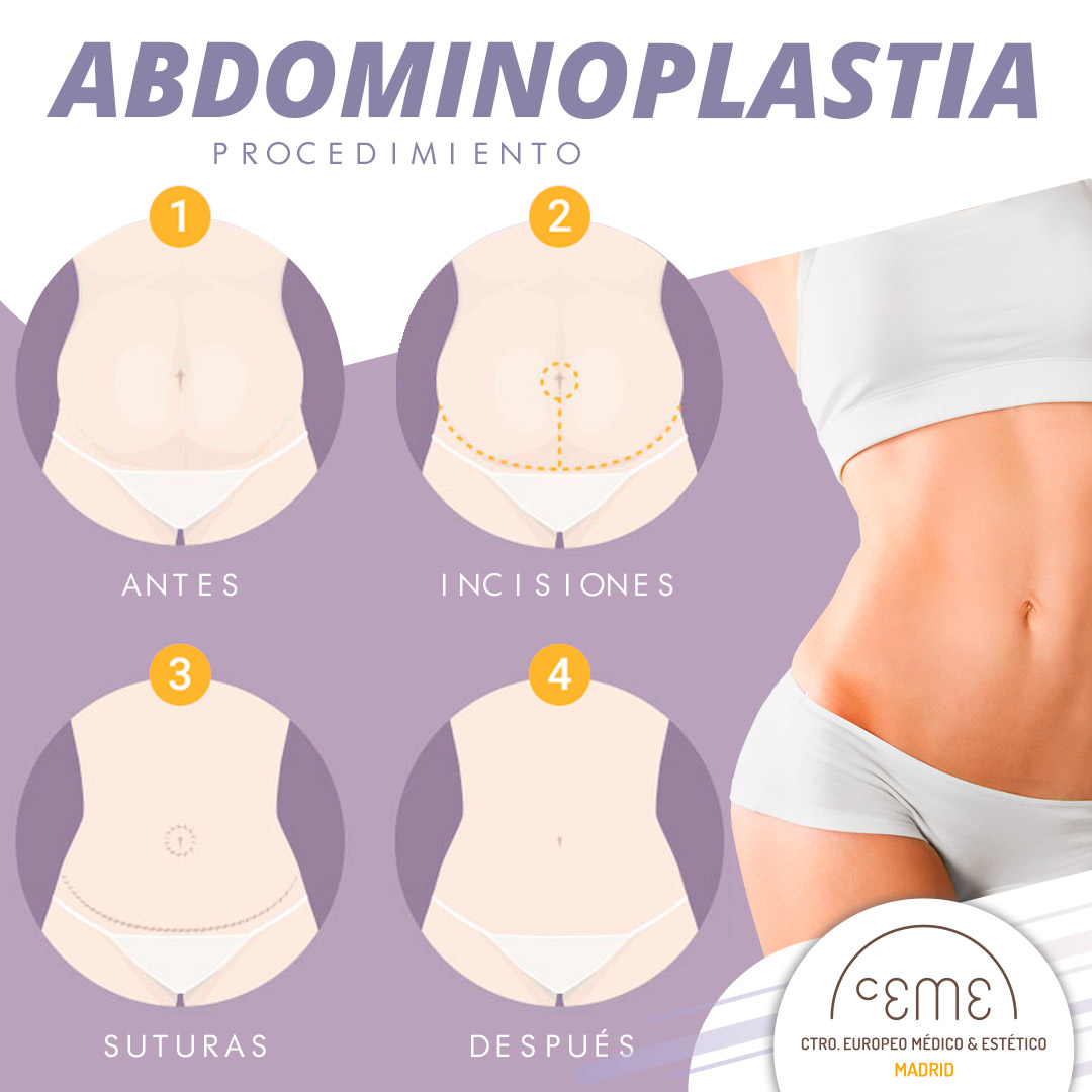 Beneficios de la Abdominoplastia - Ceme