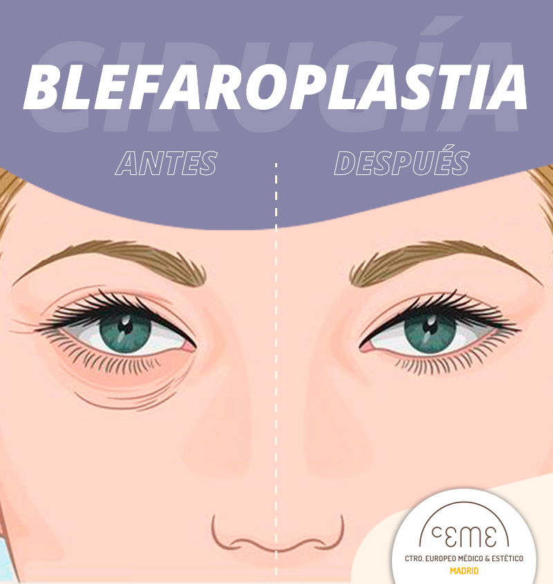 Simulación antes y despues de una Blefaroplastia