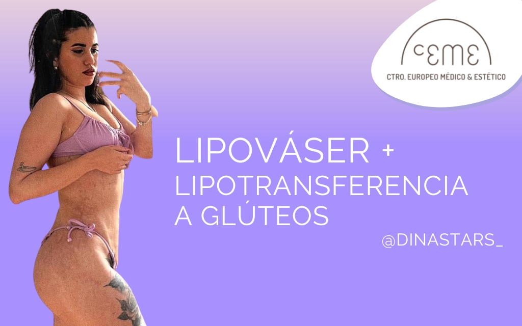 DINA STARS: Un mes luego de su cirugía Lipováser con lipotransferencia a glúteos