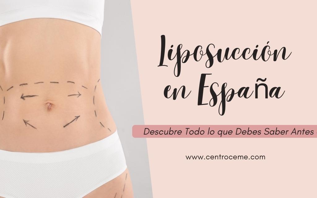 blefaroplastia-antes-y-despu-s-ceme