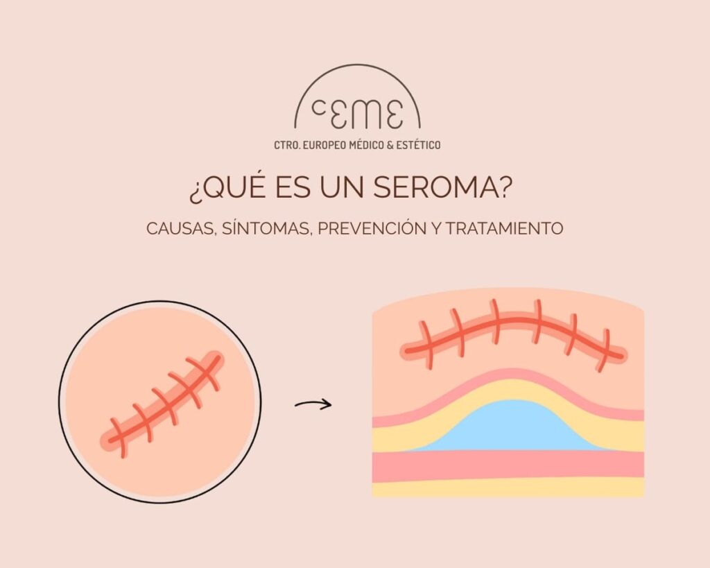 causas, síntomas, prevención y tratamiento de un seroma