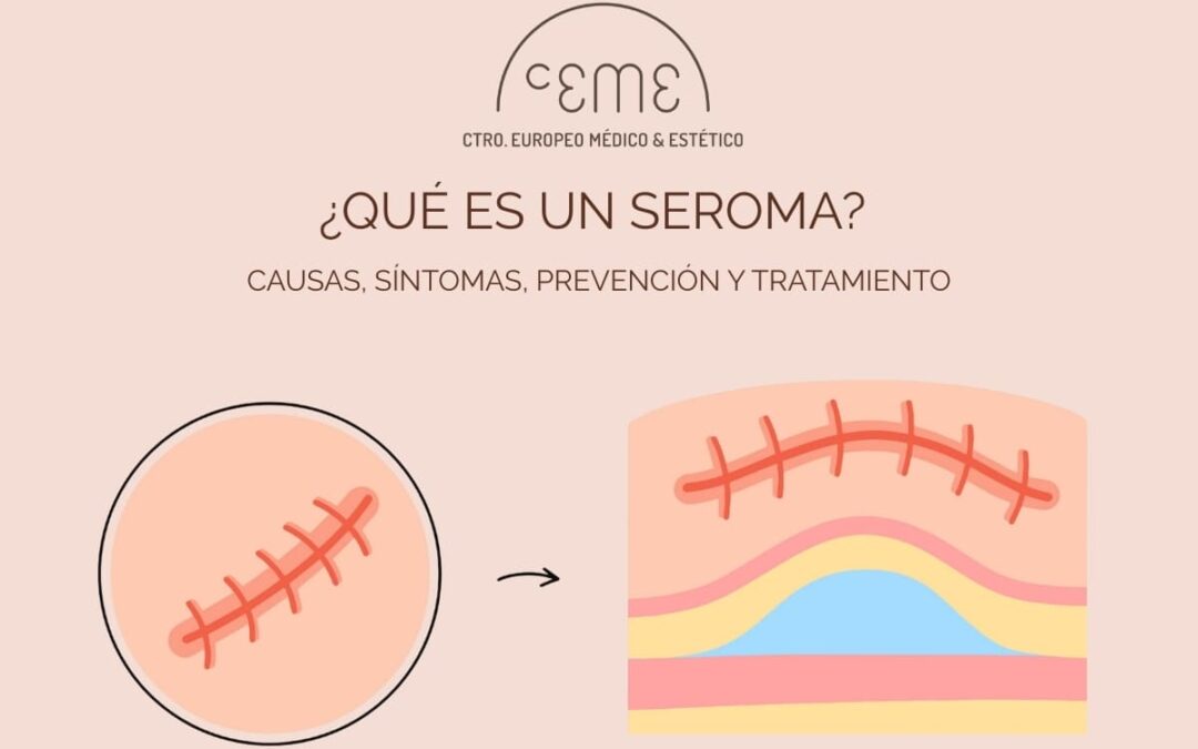 causas, síntomas, prevención y tratamiento de un seroma