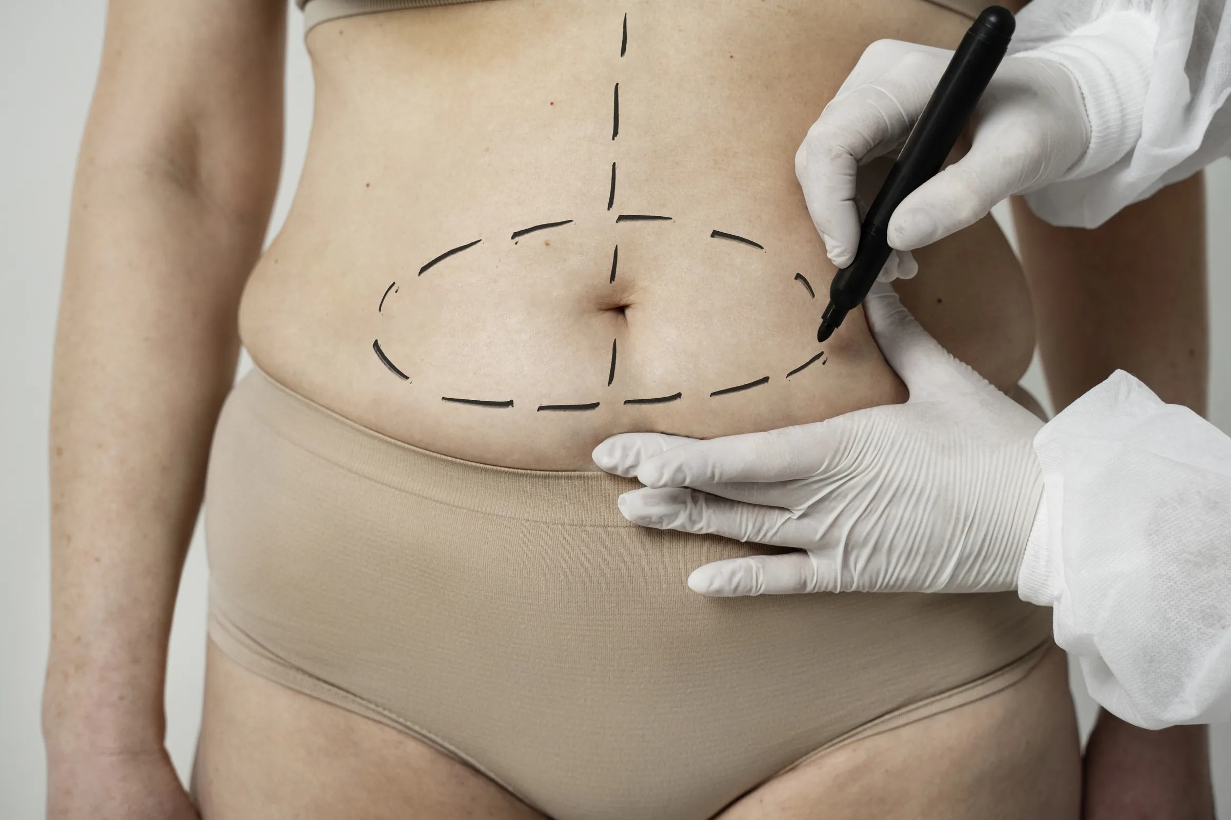 Cuánto cuesta una liposucción en Madrid y qué factores influyen en el precio. Guía completa para entender el coste de esta cirugía estética grasa