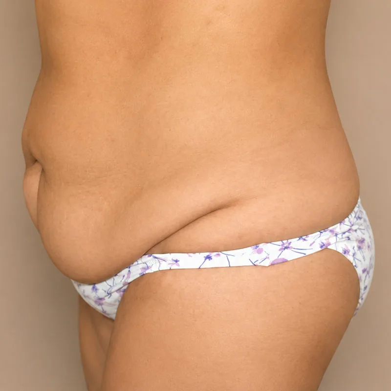 Antes de una cirugía de Abdominoplastia - caso1