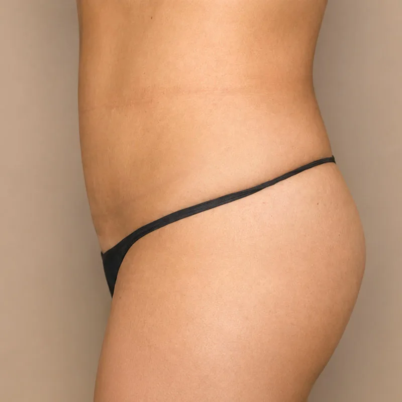 despues de una cirugía de Abdominoplastia - caso1