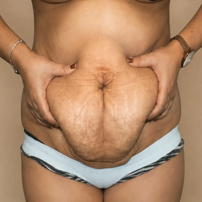 Antes de una cirugía de Abdominoplastia - caso2
