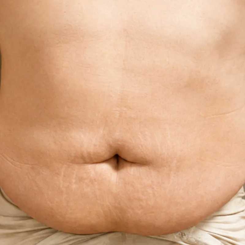 Antes de una cirugía de Abdominoplastia - caso3