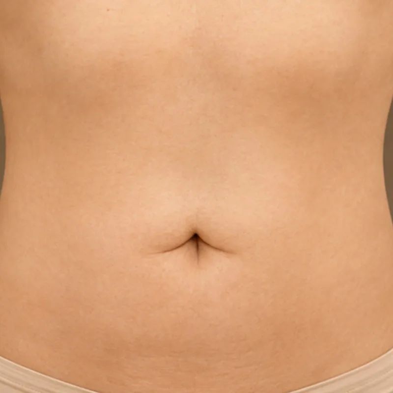 despues de una cirugía de Abdominoplastia - caso3