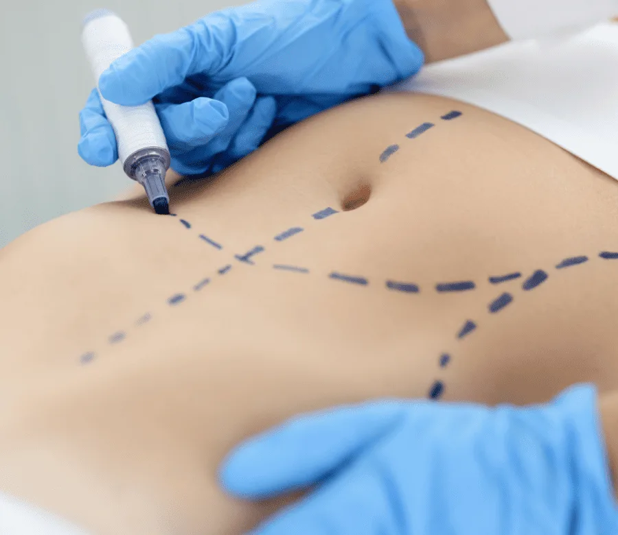 Cirugía corporal abdominoplastia inversa Madrid