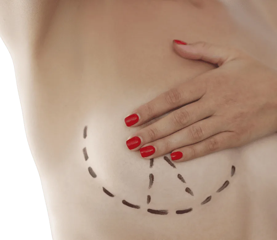 cirugia mastopexia elevación de pecho