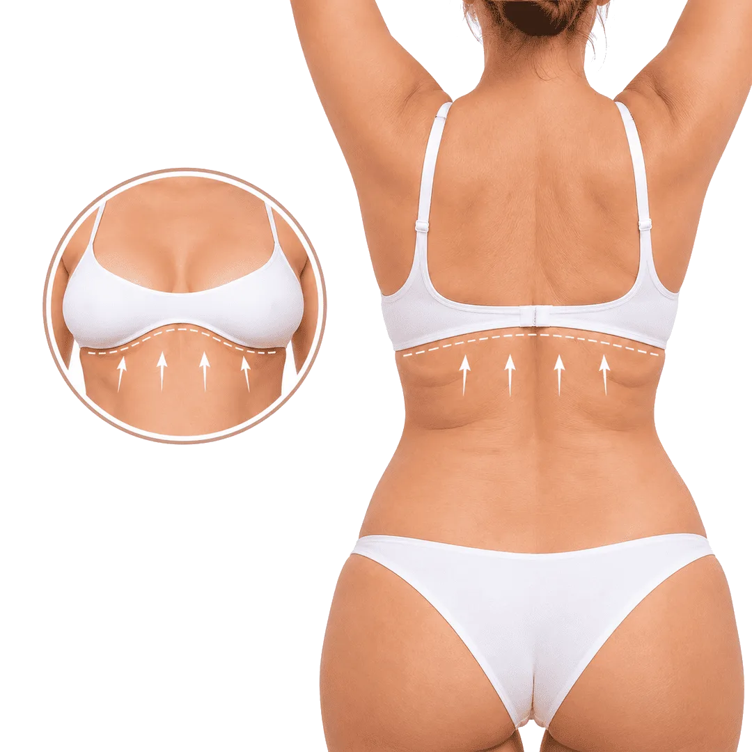 Abdominoplastia inversa para eliminar exceso de piel en la zona superior del abdomen