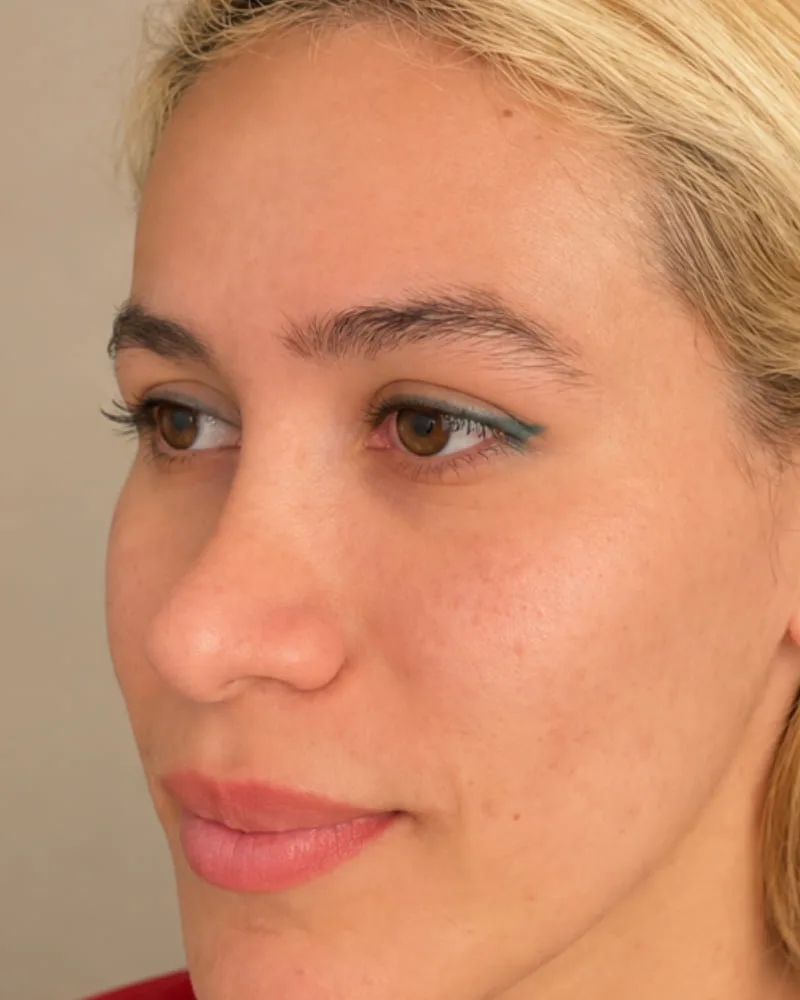 Antes de una cirugía de lifting de cejas - caso 1