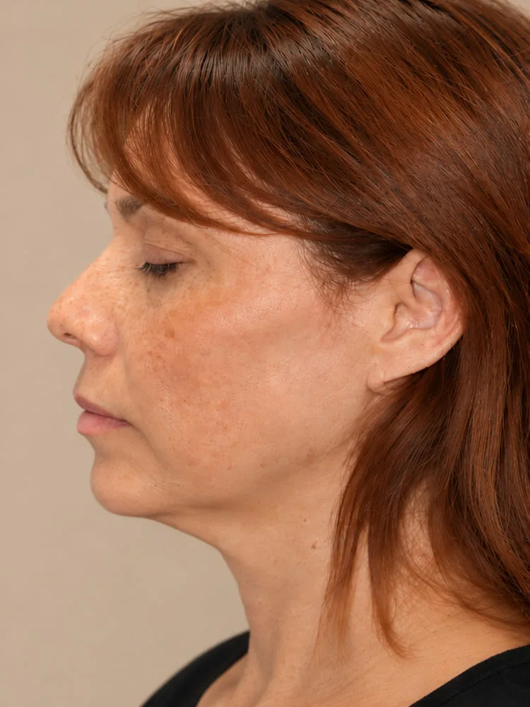 Antes de una cirugía de minilifting facial - caso 2.1