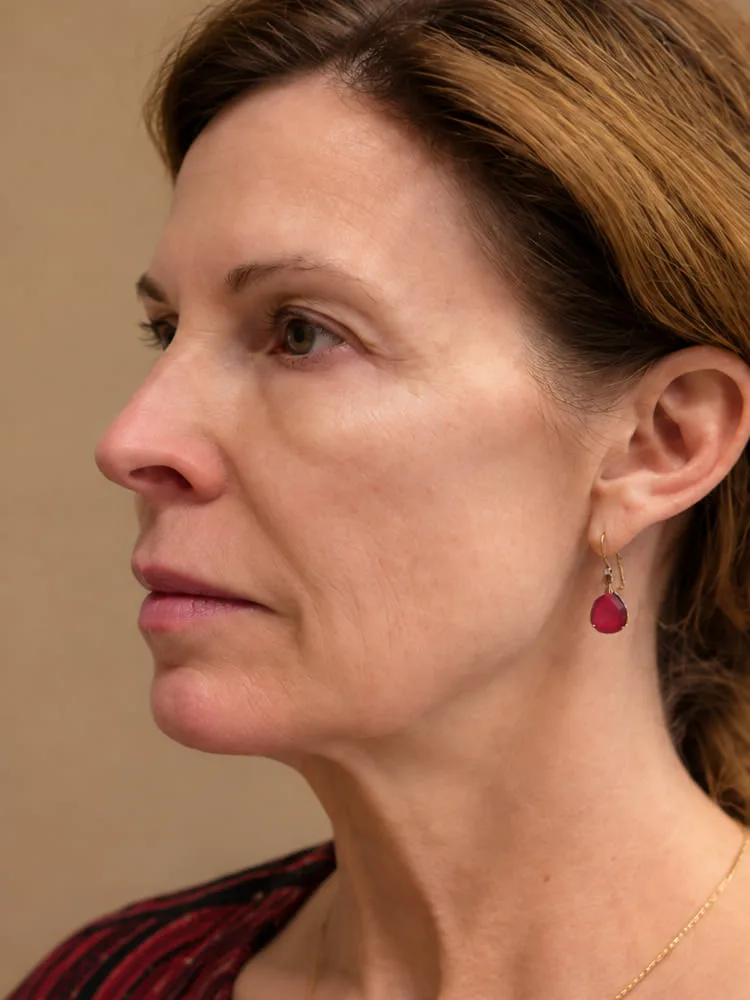Antes de una cirugía de minilifting facial - caso 3.1